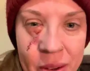 Mum looks like ‘something from zombie film’ after childhood mistake – Wales Online