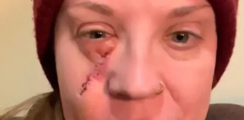 Mum looks like ‘something from zombie film’ after childhood mistake – Wales Online